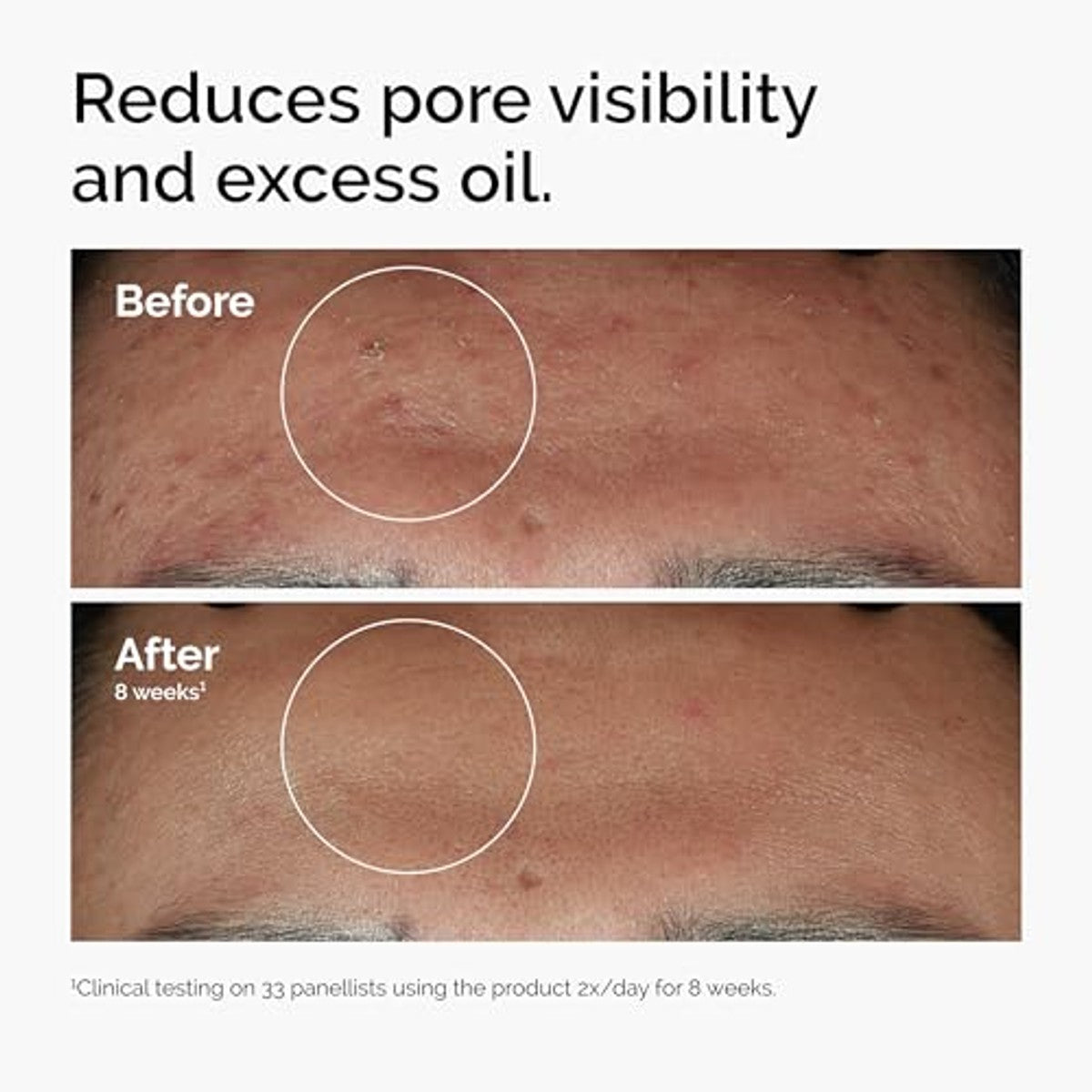 The Ordinary Niacinamide 10% + zink 1%, 30 ml