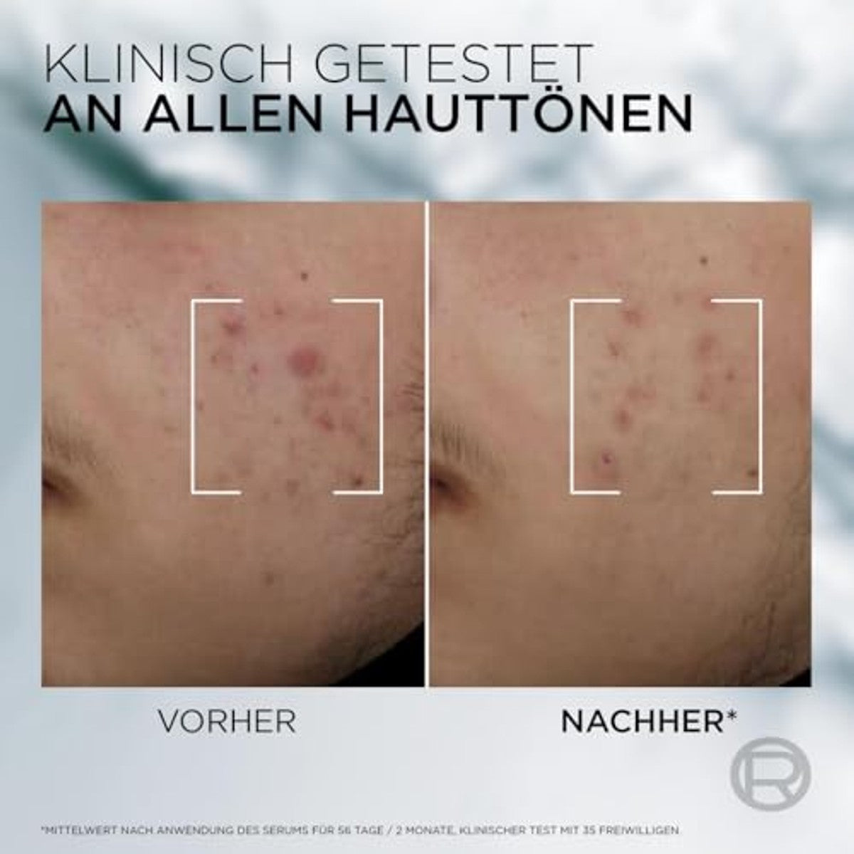 L'Oréal Men Expert Derma Control Anti-onzuiverheden Serum 3 x 30 ml - Voordeelverpakking